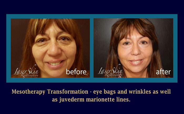 eyes mesotherapy in Rockledge